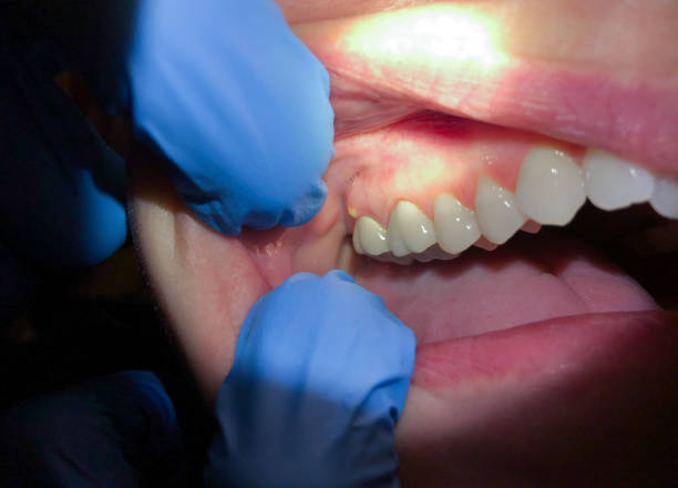 Best Emergency Dentist for Lost Fillings or Crowns in Lake Tansi, TN